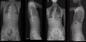 Stuburo korekcijos rentgeno vaizdai 