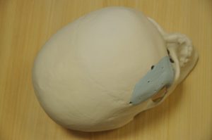 Paciento kaukolės su protezu 3D modelis